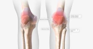 knees with arthritis