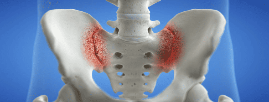A 3D image of the pelvis highlighting the red spot at the sacroiliac joint.